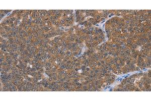 Immunohistochemistry of paraffin-embedded Human ovarian cancer using FABP6 Polyclonal Antibody at dilution of 1:30 (FABP6 抗体)