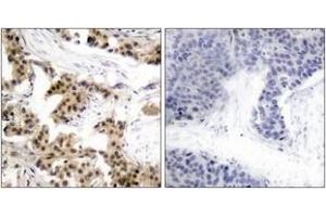 Immunohistochemistry analysis of paraffin-embedded human breast carcinoma, using NF-kappaB p105/p50 (Phospho-Ser893) Antibody. (NFKB1 抗体  (pSer893))
