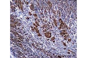 S100B antibody immunohistochemistry analysis in formalin fixed and paraffin embedded human malignant melanoma. (S100B 抗体)