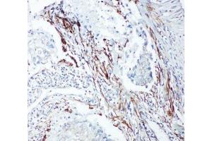 IHC-P: SHC1 antibody testing of human lung cancer tissue