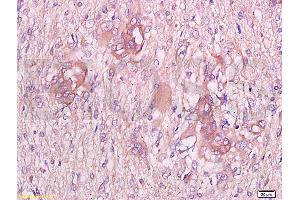 Formalin-fixed and paraffin embedded human endometrium carcinoma labeled with Anti-CGP-39/YKL-40 Polyclonal Antibody, Unconjugated at 1:300 followed by conjugation to the secondary antibody and DAB staining (CHI3L1 抗体  (AA 330-381))