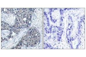 Immunohistochemical analysis of paraffin-embedded human breast carcinoma tissue using eIF4E(Phospho-Ser209) Antibody(left) or the same antibody preincubated with blocking peptide(right). (EIF4E 抗体  (pSer209))