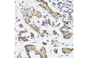 Immunohistochemistry of paraffin-embedded human breast cancer using DHRS2 antibody. (DHRS2 抗体  (AA 1-300))