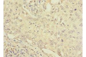 Immunohistochemistry of paraffin-embedded human lung cancer using ABIN7152656 at dilution of 1:100 (FCRL2 抗体  (AA 20-100))