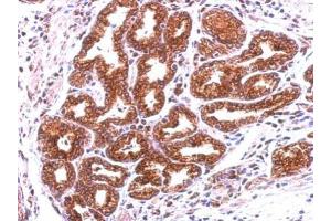 IHC-P Image Immunohistochemical analysis of paraffin-embedded human colon carcinoma, using Annexin A13, antibody at 1:500 dilution. (Annexin A13 抗体  (N-Term))