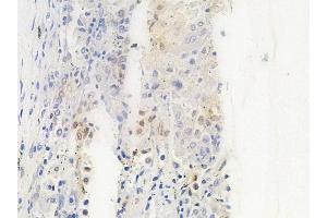 ABIN6263071 and ABIN6266879 at 1/100 staining human lung squamous cell carcinoma by IHC-P. (Melanoma Antigen Family D, 4 (MAGED4) (C-Term) 抗体)
