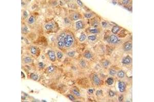 AMACR antibody immunohistochemistry analysis in formalin fixed and paraffin embedded human hepatocarcinoma. (AMACR 抗体  (AA 323-351))