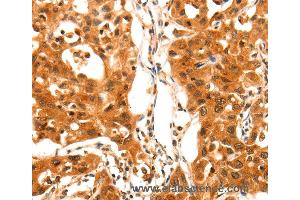 Immunohistochemistry of Human lung cancer using SERPINB5 Polyclonal Antibody at dilution of 1:60 (SERPINB5 抗体)