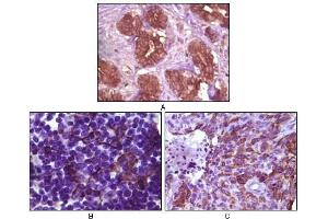 Immunohistochemical analysis of paraffin-embedded human breast tissue (A), lymph tissue (B) and skin carcinoma (C), showing membrane localization using BLK antibody with DAB staining. (BLK 抗体)