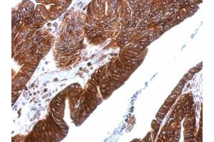 IHC-P Image Thrombomodulin antibody [C3], C-term detects THBD protein at cytosol and membrane on human gastric cancer by immunohistochemical analysis. (Thrombomodulin 抗体  (C-Term))