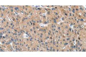 Immunohistochemistry of paraffin-embedded Human liver cancer tissue using DSC1 Polyclonal Antibody at dilution 1:40 (Desmocollin 1 抗体)
