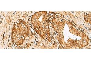 Immunohistochemistry of paraffin-embedded Human prost at e cancer tissue using DHRS2 Polyclonal Antibody at dilution of 1:55(x200) (DHRS2 抗体)