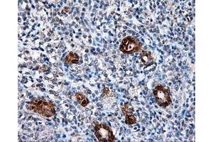 Immunohistochemical staining of paraffin-embedded Adenocarcinoma of colon tissue using anti-L1CAM mouse monoclonal antibody. (L1CAM 抗体)