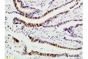 Formalin-fixed and paraffin-embedded : human colon carcinoma labeled with Rabbit Anti-Integrin αVβ1 Polyclonal Antibody , Unconjugated 1:200 followed by conjugation to the secondary antibody and DAB staining (ITGAV/ITGB1 抗体)