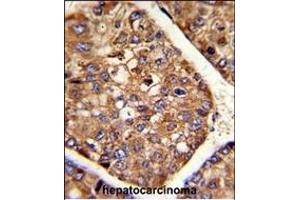 Formalin-fixed and paraffin-embedded human hepatocarcinoma reacted with P4HB Antibody (C-term), which was peroxidase-conjugated to the secondary antibody, followed by DAB staining. (P4HB 抗体  (C-Term))