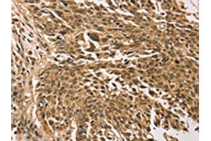 The image on the left is immunohistochemistry of paraffin-embedded Human lung cancer tissue using ABIN7192784(TGM7 Antibody) at dilution 1/30, on the right is treated with synthetic peptide. (Transglutaminase 7 抗体)