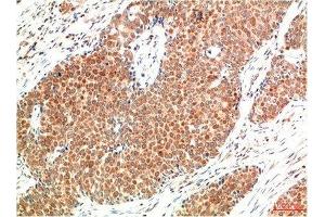 Immunohistochemical analysis of paraffin-embedded Human Breast Carcinoma Tissue using ATM Mouse mAb diluted at 1:200. (ATM 抗体)