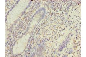 Immunohistochemistry of paraffin-embedded human colon cancer using ABIN7159710 at dilution of 1:100 (MFAP3L 抗体  (AA 29-102))