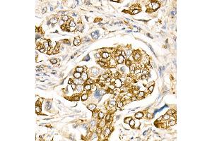 Immunohistochemistry of paraffin-embedded Human lung cancer using FasLG antibody (ABIN3020741, ABIN3020742, ABIN3020743, ABIN1512897 and ABIN6213701) at dilution of 1:150 (40x lens). (FASL 抗体  (AA 100-200))