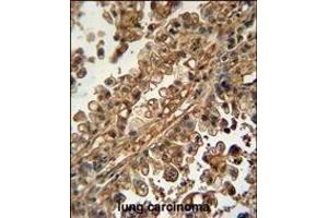 ABCG1 Antibody (N-term) (ABIN390432 and ABIN2840817) immunohistochemistry analysis in formalin fixed and paraffin embedded human lung carcinoma followed by peroxidase conjugation of the secondary antibody and DAB staining.