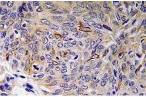 Immunohistochemistry (IHC) analyzes of IL-32 antibody in paraffin-embedded human lung carcinoma tissue. (IL32 抗体)