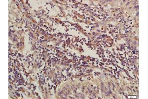 Formalin-fixed and paraffin embedded human laryngeal carcinoma labeled with Rabbit Anti-C4orf21 Polyclonal Antibody, Unconjugated (ABIN1714408) at 1:200 followed by conjugation to the secondary antibody and DAB staining (ZGRF1 抗体  (AA 101-200))