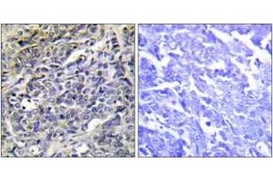 Immunohistochemistry analysis of paraffin-embedded human lung carcinoma tissue, using GRAK Antibody. (GZMK 抗体  (AA 61-110))