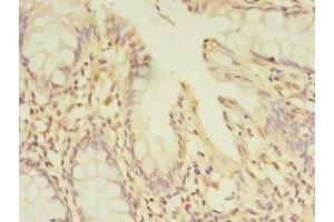 Immunohistochemistry of paraffin-embedded human colon cancer using ABIN7165911 at dilution of 1:100 (PELO 抗体  (AA 1-385))
