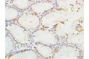 Formalin-fixed and paraffin embedded human gastric carcinoma labeled with Anti-phospho-YES1(Tyr426) Polyclonal Antibody, Unconjugated  at 1:200 followed by conjugation to the secondary antibody and DAB staining (YES1 抗体  (pTyr426))
