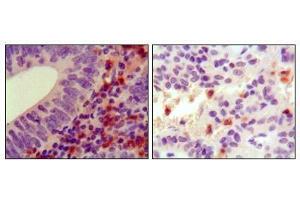Immunohistochemical analysis of paraffin-embedded human colon cancer (left) and ancreas cancer (right), showing cytoplasmic localization using HCK antibody with DAB staining. (HCK 抗体)