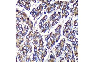 Immunohistochemistry of paraffin-embedded Human liver cancer using UGT1 Rabbit pAb (ABIN6132769, ABIN6149895, ABIN6149896 and ABIN6221779) at dilution of 1:100 (40x lens). (UGT1A1 抗体  (AA 1-200))