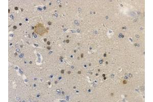 ABIN6256367 and ABIN6267348 at 1/100 staining human glioblastoma by IHC-P.