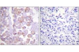 Immunohistochemistry analysis of paraffin-embedded human breast carcinoma tissue, using Synuclein (Ab-129) Antibody. (Synuclein 抗体  (AA 91-140))