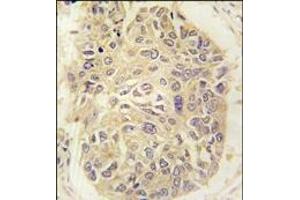Formalin-fixed and paraffin-embedded human lung carcinoma tissue reacted with FARSA antibody (N-term), which was peroxidase-conjugated to the secondary antibody, followed by DAB staining. (Phenylalanyl-tRNA Synthetase, alpha Subunit (FARSA) (N-Term) 抗体)