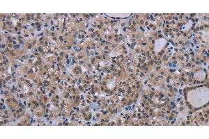 Immunohistochemistry of paraffin-embedded Human thyroid cancer tissue using MAGEC1 Polyclonal Antibody at dilution 1:30 (MAGEC1 抗体)