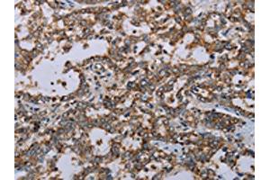 The image on the left is immunohistochemistry of paraffin-embedded Human liver cancer tissue using ABIN7191485(MMP23B Antibody) at dilution 1/20, on the right is treated with synthetic peptide. (MMP23A 抗体)