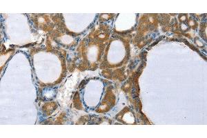 Immunohistochemistry of paraffin-embedded Human thyroid cancer using PPP2CA Polyclonal Antibody at dilution of 1:35 (PPP2CA 抗体)