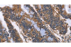 Immunohistochemistry of paraffin-embedded Human colon cancer using ILK Polyclonal Antibody at dilution of 1:50 (ILK 抗体)