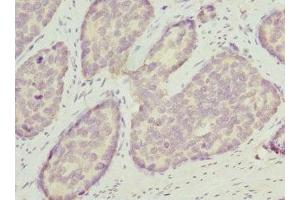 Immunohistochemistry of paraffin-embedded human gastric cancer using ABIN7162209 at dilution of 1:100 (Oligophrenin 1 抗体  (AA 1-270))