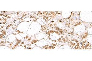 Immunohistochemistry of paraffin-embedded Human breast cancer tissue using RBFOX2 Polyclonal Antibody at dilution of 1:80(x200) (RBM9 抗体)