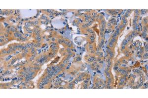 Immunohistochemistry of paraffin-embedded Human thyroid cancer using CD327 Polyclonal Antibody at dilution of 1:70 (SIGLEC6 抗体)