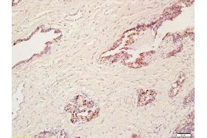 Formalin-fixed and paraffin embedded human prostate labeled with Anti-Cyclooxygenase-2 Polyclonal Antibody, Unconjugated  at 1:200 followed by conjugation to the secondary antibody and DAB staining