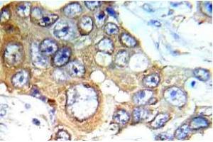Immunohistochemistry (IHC) analyzes of c-RAF antibody in paraffin-embedded human breast carcinoma tissue. (RAF1 抗体)