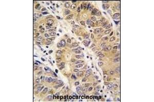 Formalin-fixed and paraffin-embedded human hepatocarcinoma tissue reacted with P13 antibody (C-term), which was peroxidase-conjugated to the secondary antibody, followed by DAB staining. (MMP13 抗体  (C-Term))