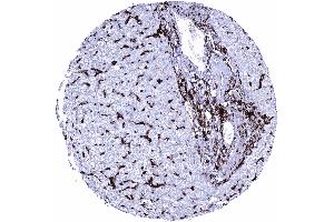 Liver Intense HLA DRB1 staining of inflammatory cells and of Kupffer cells HLA DRB1 immunohistochemistry