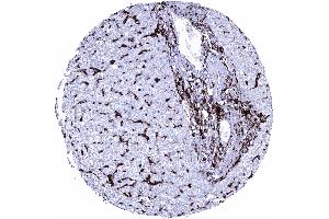 Liver Intense HLA DRB1 staining of inflammatory cells and of Kupffer cells HLA DRB1 immunohistochemistry (Recombinant HLA-DRB1 抗体)