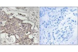 Immunohistochemistry analysis of paraffin-embedded human breast carcinoma tissue, using HIBADH Antibody. (HIBADH 抗体  (AA 281-330))