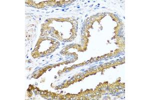 Immunohistochemistry of paraffin-embedded human prostate using NCK2 antibody (ABIN6128332, ABIN6144407, ABIN6144408 and ABIN6223694) at dilution of 1:100 (40x lens). (NCK2 抗体  (AA 1-380))