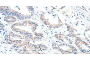 Immunohistochemistry of paraffin-embedded Human colon cancer using ALDH1A2 Polyclonal Antibody at dilution of 1:60 (ALDH1A2 抗体)