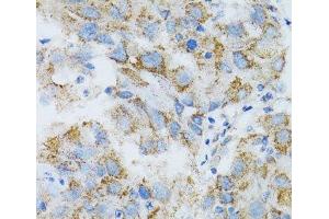 Immunohistochemistry of paraffin-embedded Human breast cancer using PSMD10 Polyclonal Antibody at dilution of 1:100 (40x lens). (PSMD10 抗体)